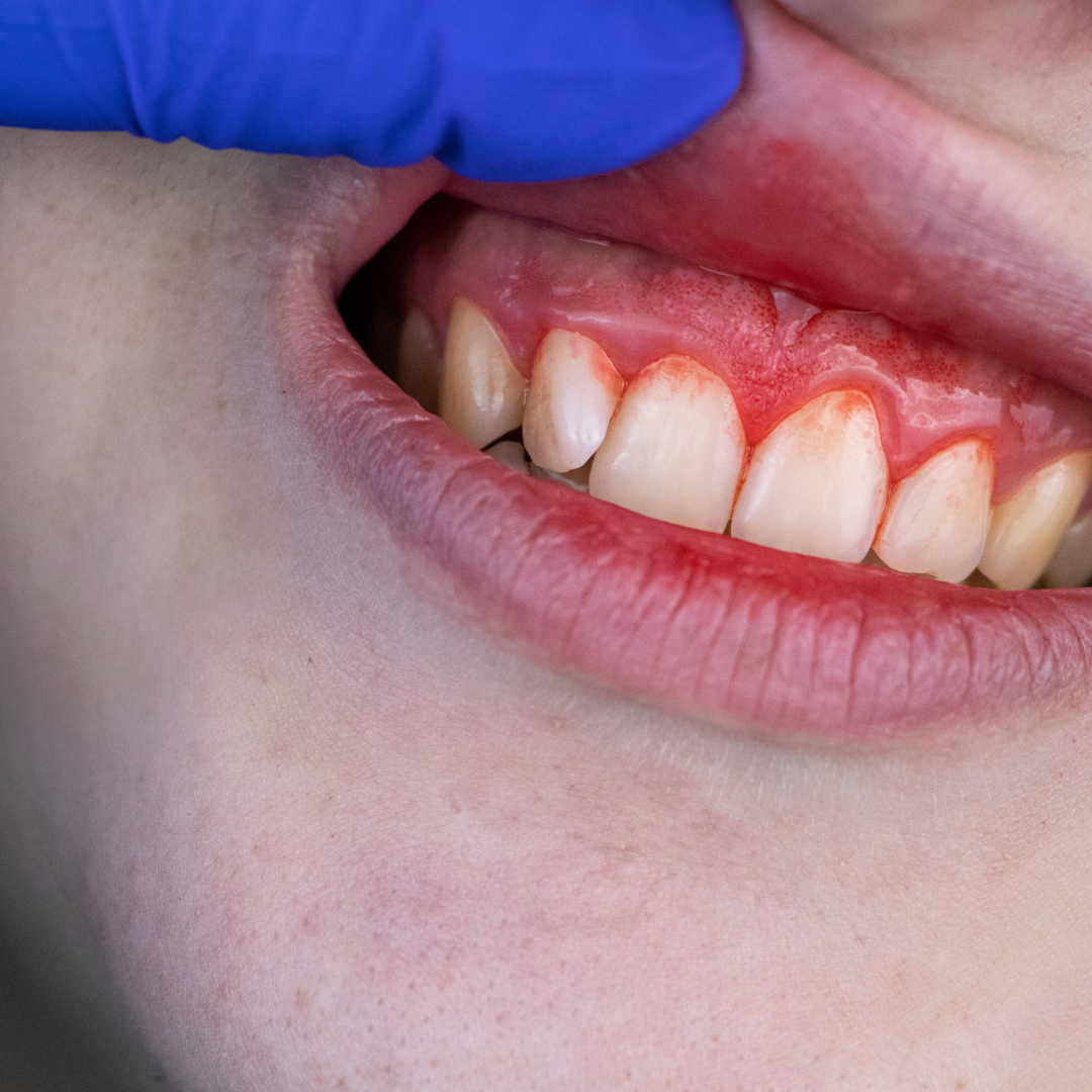 Dermatologia em João Pessoa - Periodontia