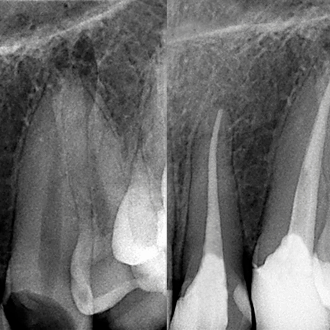 Dermatologia em João Pessoa - Endodontia